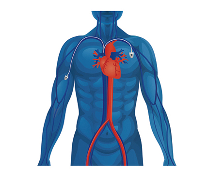 port implantable 11